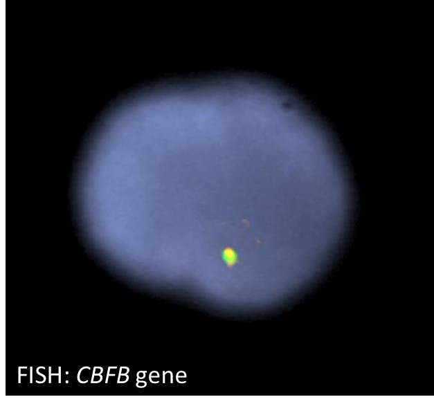 Image 6. FISH for CBFB gene demonstrates deletion of one copy of CBFB gene in 86% of cells. A rearrangement was not detected within the remaining copy observed in this microphotograph.